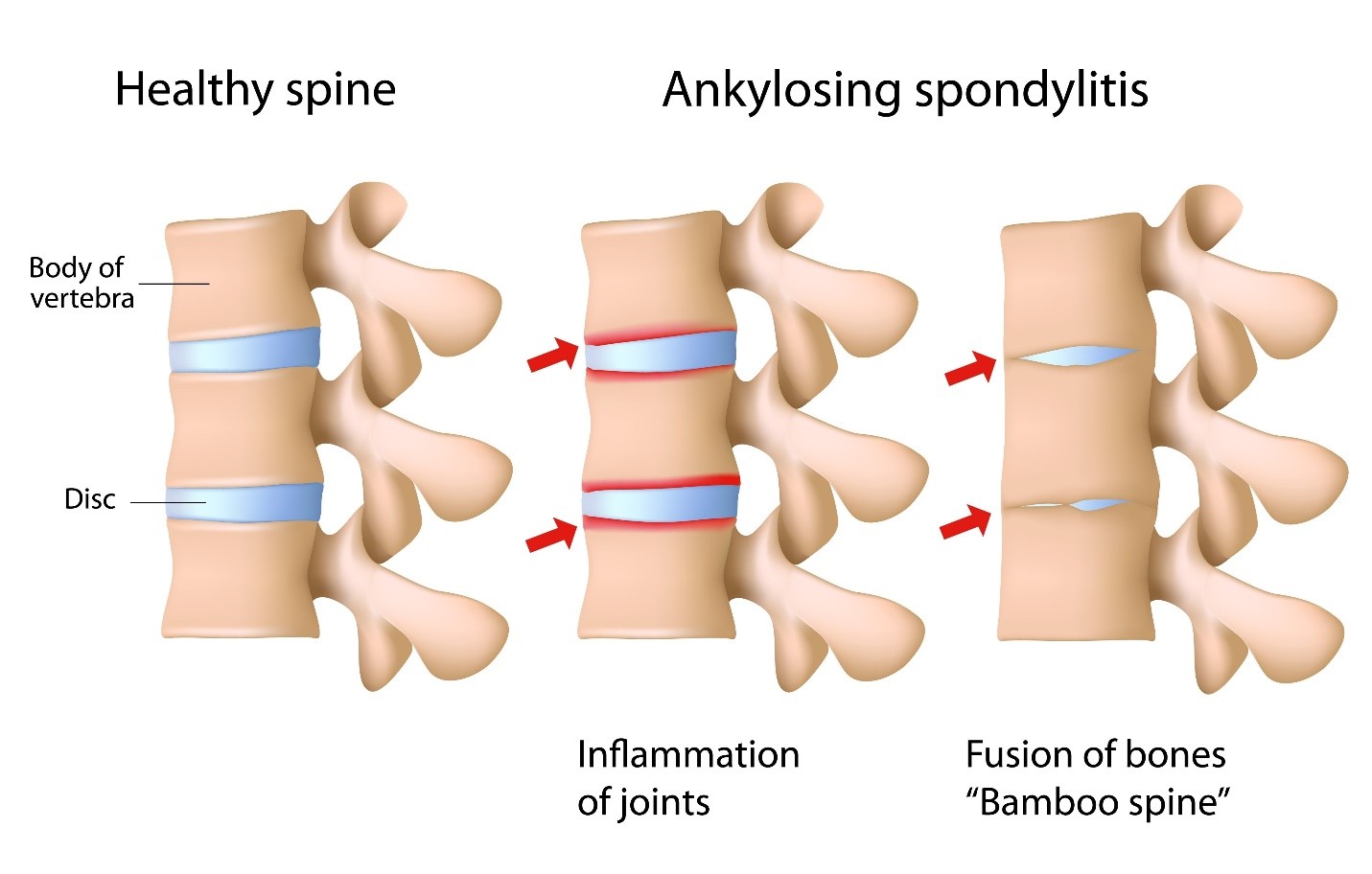 Ankylosing Spondylitis Treatment in Mumbai – Move Freely Again
