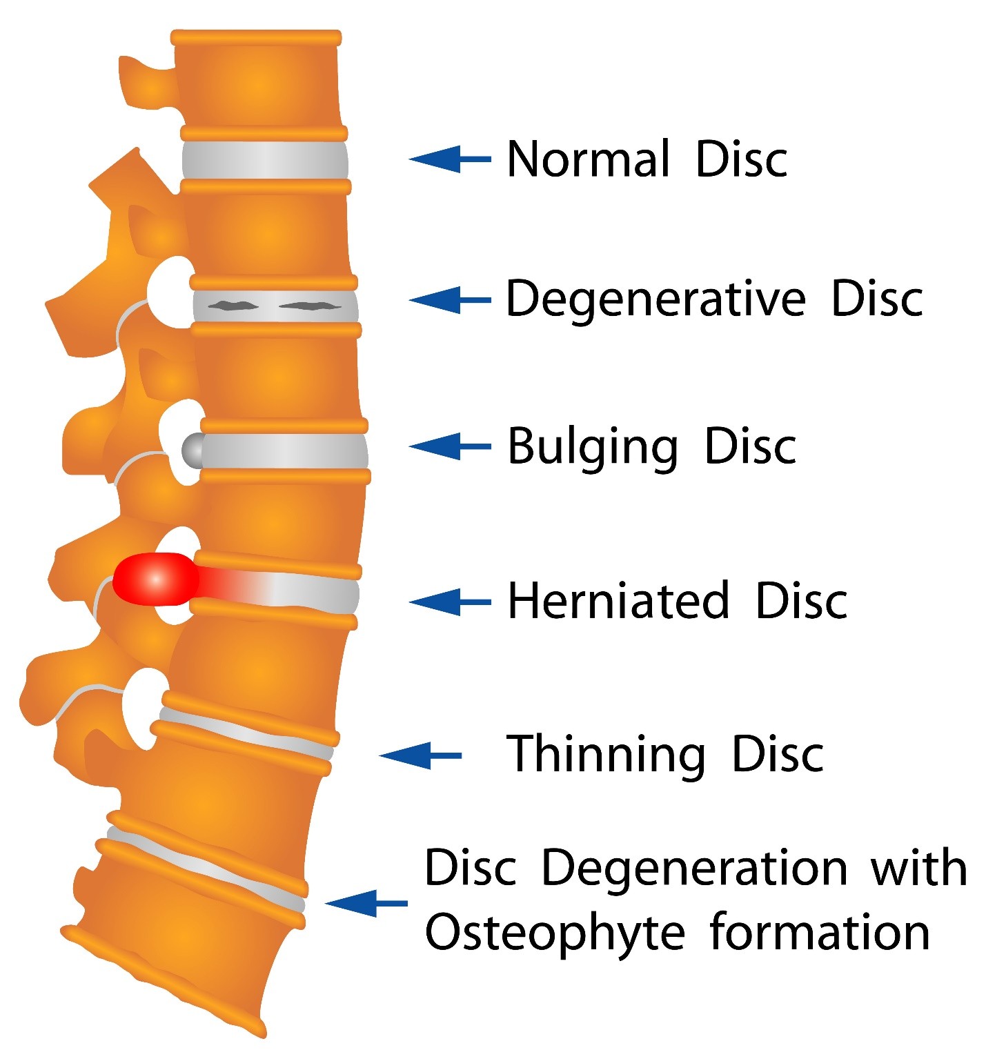 Slipped Disc Treatment in Mumbai (Andheri West)
