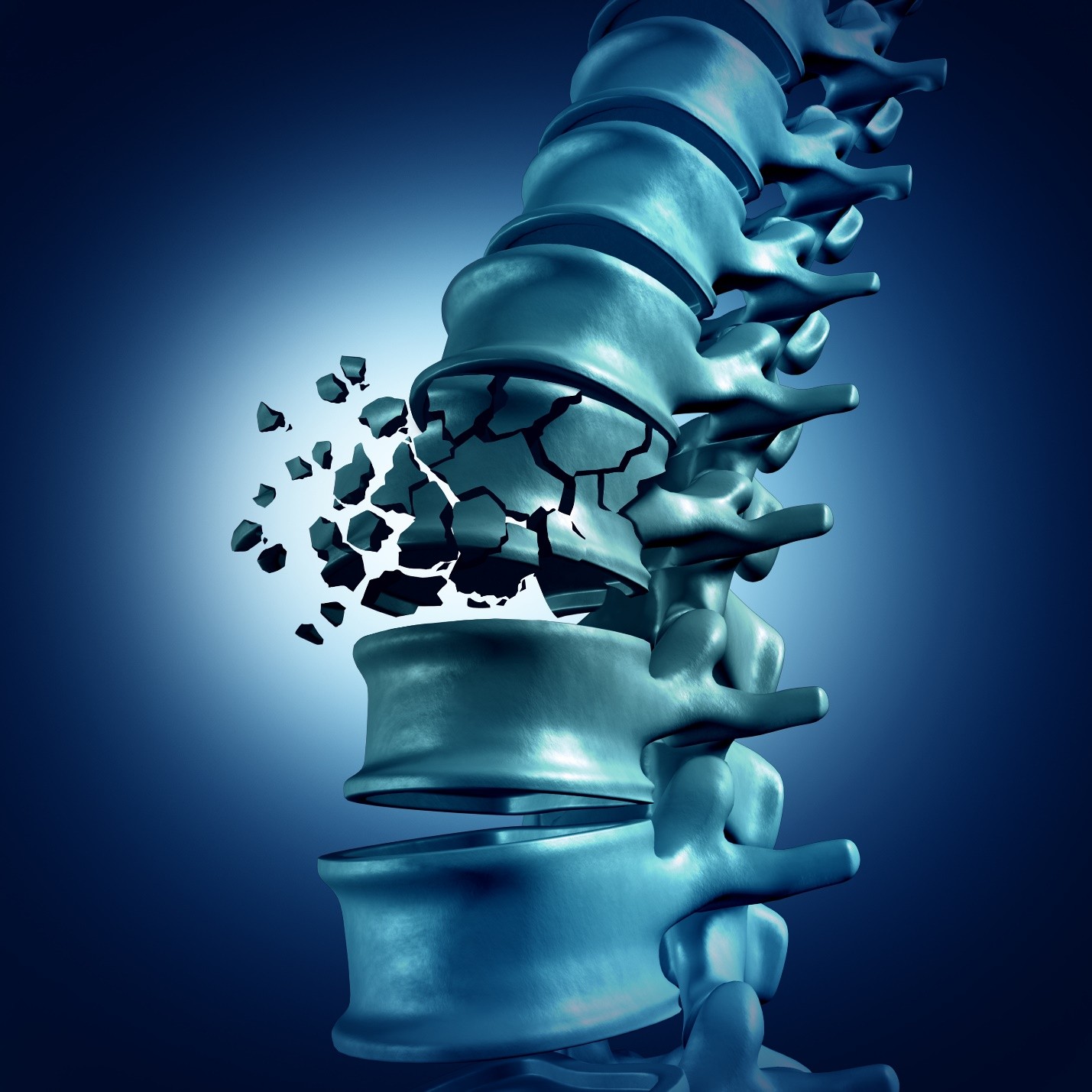 3D rendering of a human spine with a fractured vertebra
